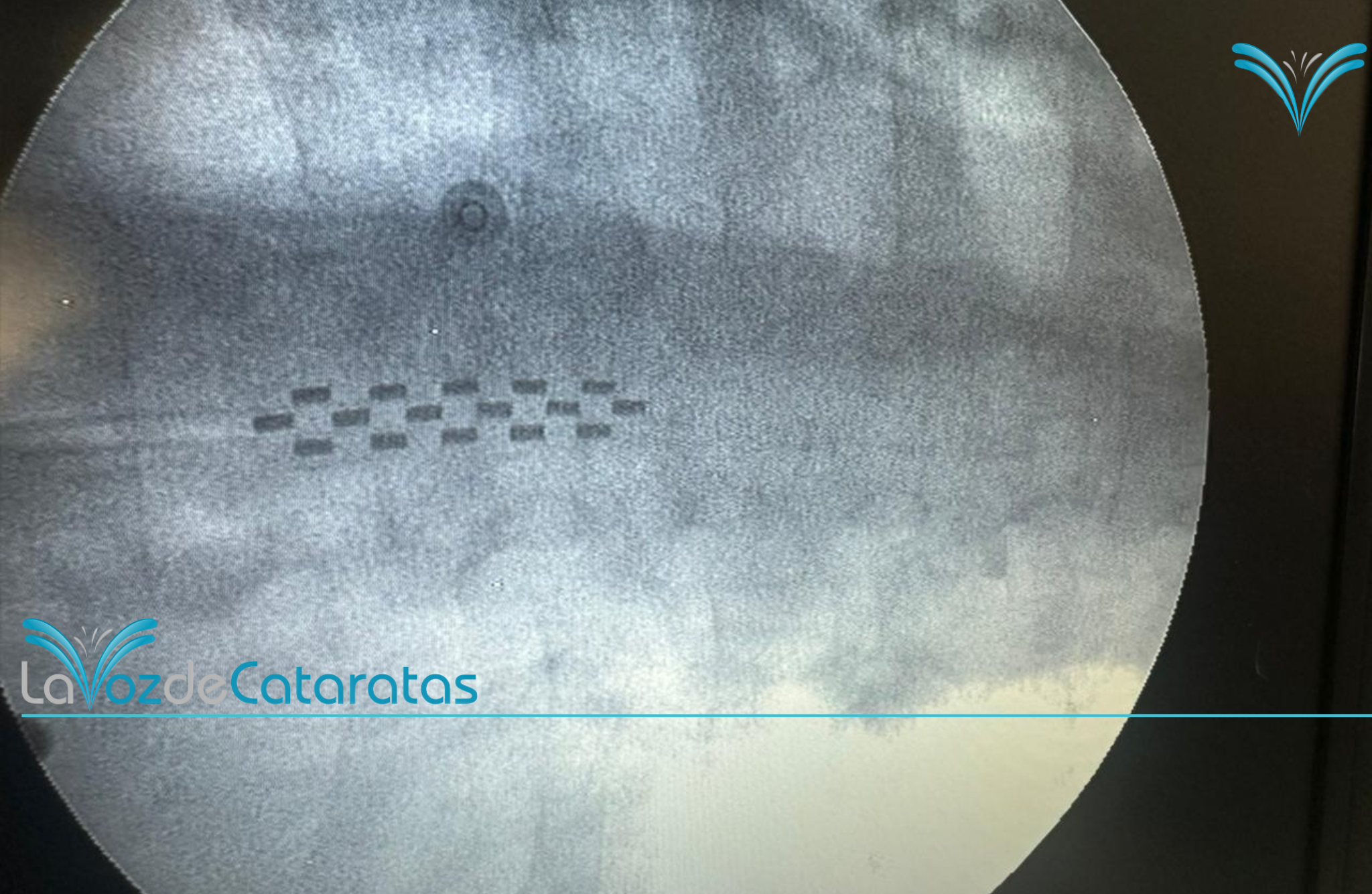 El SAMIC Iguazú realizó el primer implante de neuroestimulador para tratar el dolor imagen-12