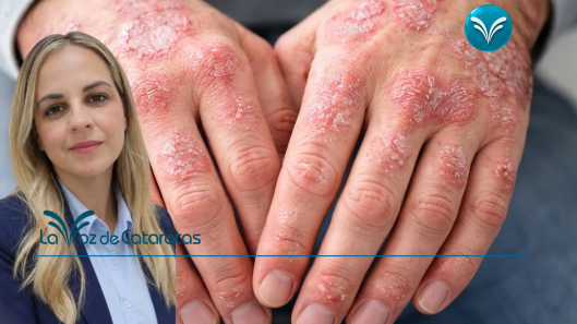 “La psoriasis no es contagiosa”_ el mensaje de una especialista para derribar mitos